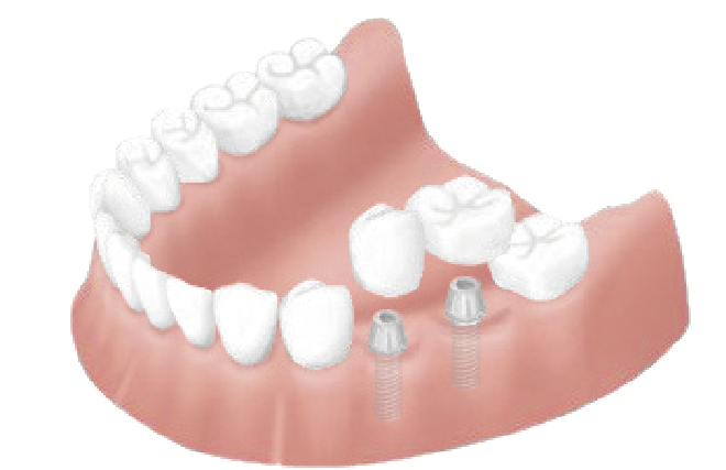インプラントは天然の歯のような根に歯を被せます。