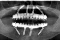 治療後の口の中のレントゲン写真